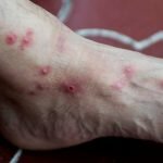 Monkeypox in La Paz; Second Case Reported in Baja California Sur