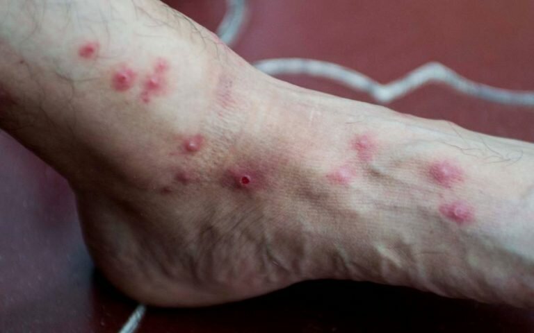 Smallpox in La Paz, second case reported